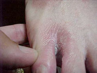 Foot with Candida mould infection